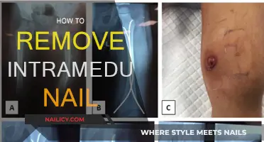 Intramedullary Nail Removal: A Step-by-Step Guide