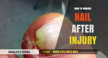 Treating an Injured Nail: Removal and Recovery