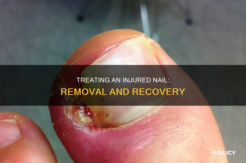 how to remove nail after injury