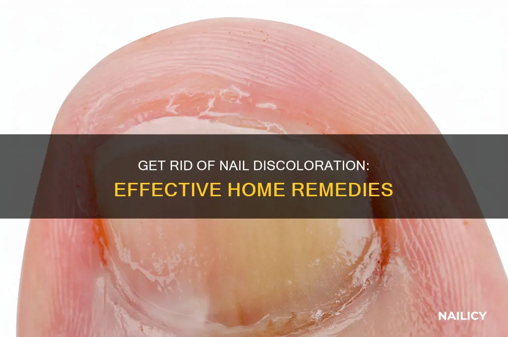 how to remove nail discoloration