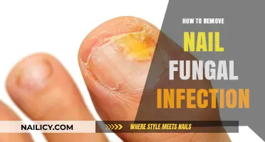 Eradicating Nail Fungal Infections: Effective Home Remedies