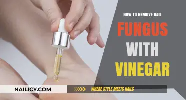 Natural Nail Fungus Treatment: Vinegar to the Rescue