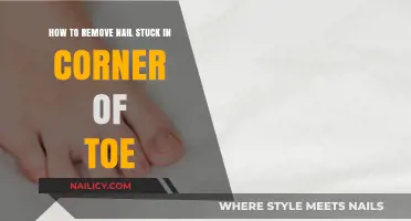 Quickly Remove Embedded Nails from Your Toe Corners