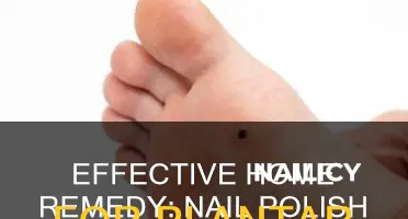 how to remove plantar warts with nail polish