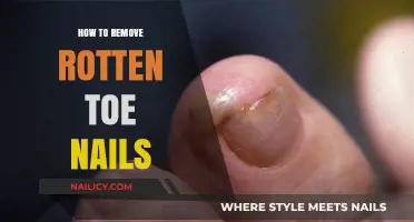 Effective Home Remedies for Removing Rotten Toenails