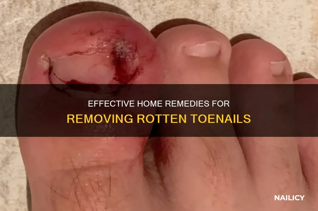 how to remove rotten toe nails
