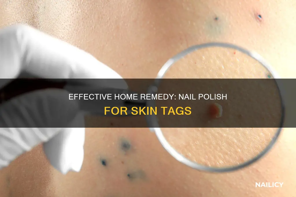 how to remove skin tags at home with nail polish