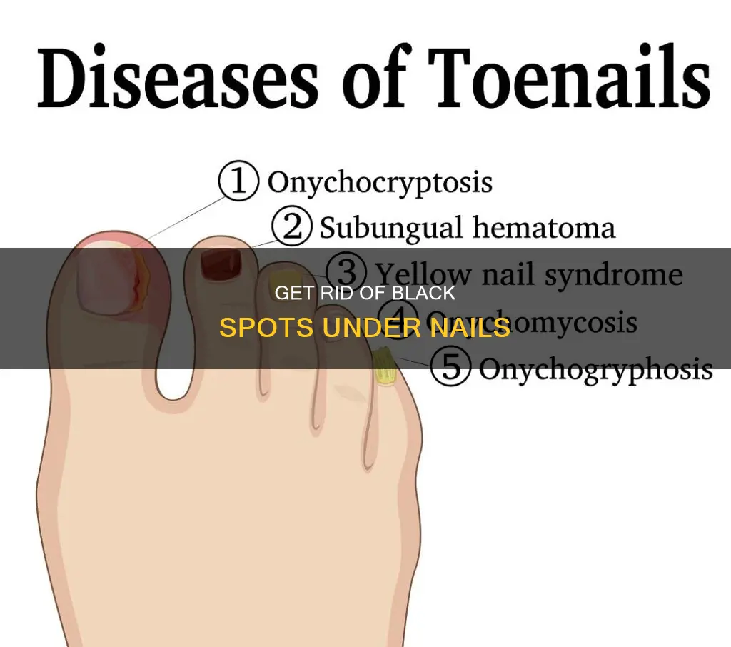 how to remove the black spot under your nail