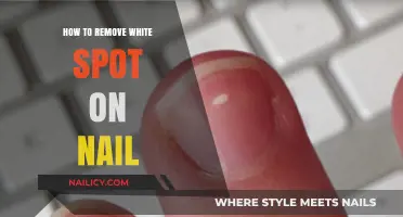 Get Rid of White Spots on Nails