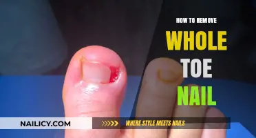 Quickly and Safely Remove an Ingrown Toenail