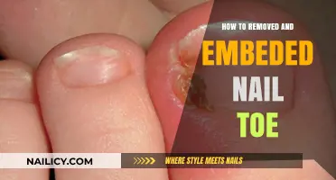 Quickly and Safely Remove an Ingrown Toenail