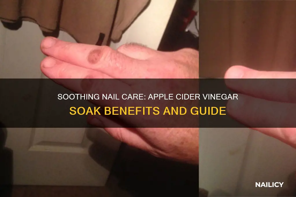 how to soak nail in apple cider vinegar