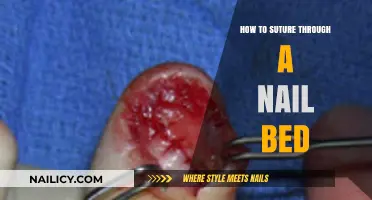 Mastering Nail Bed Suturing: Essential Techniques for Effective Wound Closure