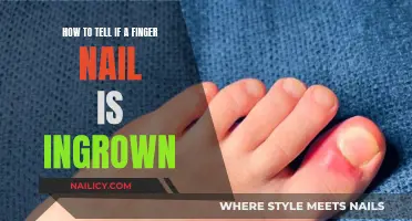 Recognizing Ingrown Fingernails: What to Look For