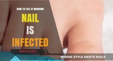 Signs Your Ingrown Nail Is Infected: Symptoms and Treatment Tips