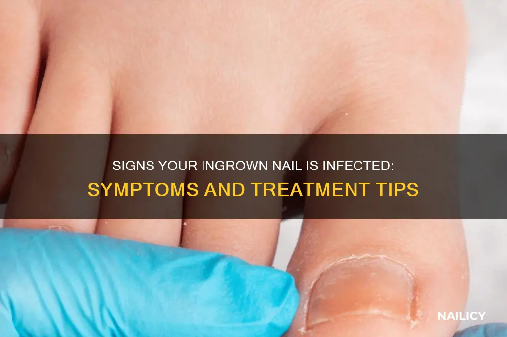 how to tell if ingrown nail is infected