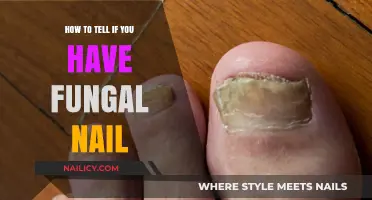 Identifying Fungal Nail Infections: Symptoms, Causes, and Early Detection Tips