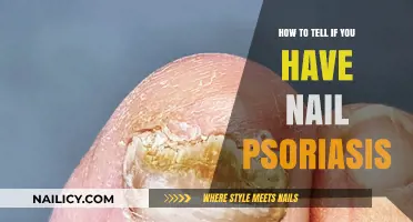 Identifying Nail Psoriasis: Key Symptoms and Early Detection Tips