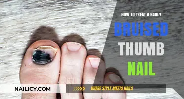 Effective Remedies for Healing a Badly Bruised Thumb Nail Fast