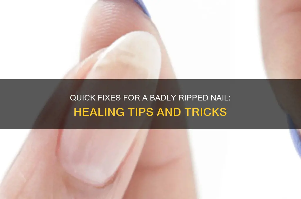 how to treat a badly ripped nail