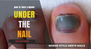 Effective Ways to Treat and Heal a Bruise Under the Nail