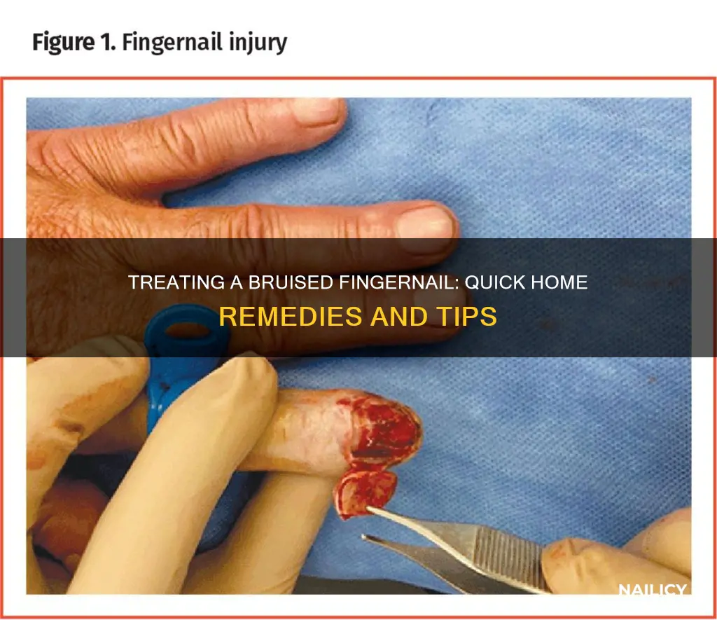 how to treat a bruised finger nail