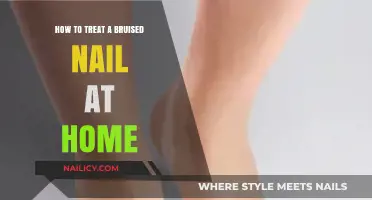 Effective Home Remedies for Healing a Bruised Nail Quickly