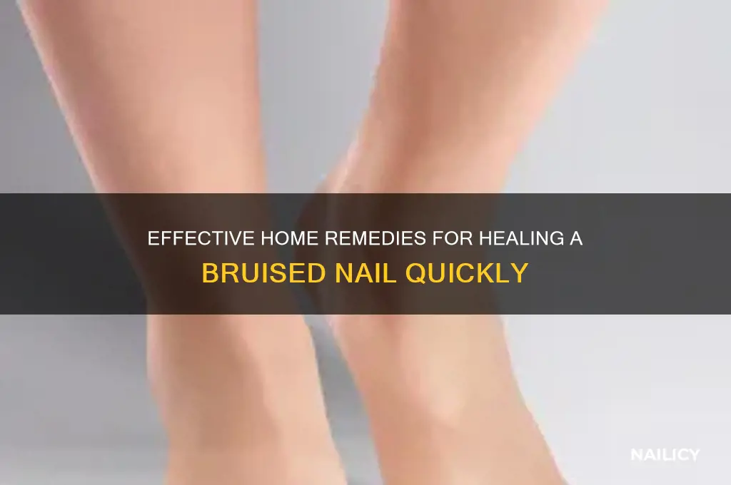 how to treat a bruised nail at home