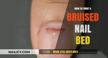 Effective Remedies for Healing and Soothing a Bruised Nail Bed
