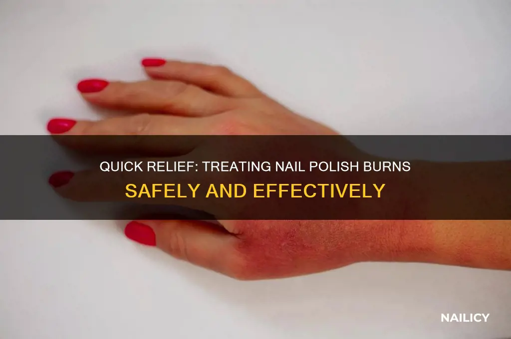 how to treat a burn from nail polish
