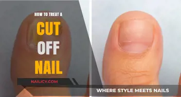 Treating Cut Nails: Quick Home Remedies