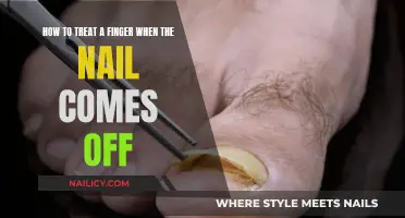 Treat a Finger: When the Nail Comes Off