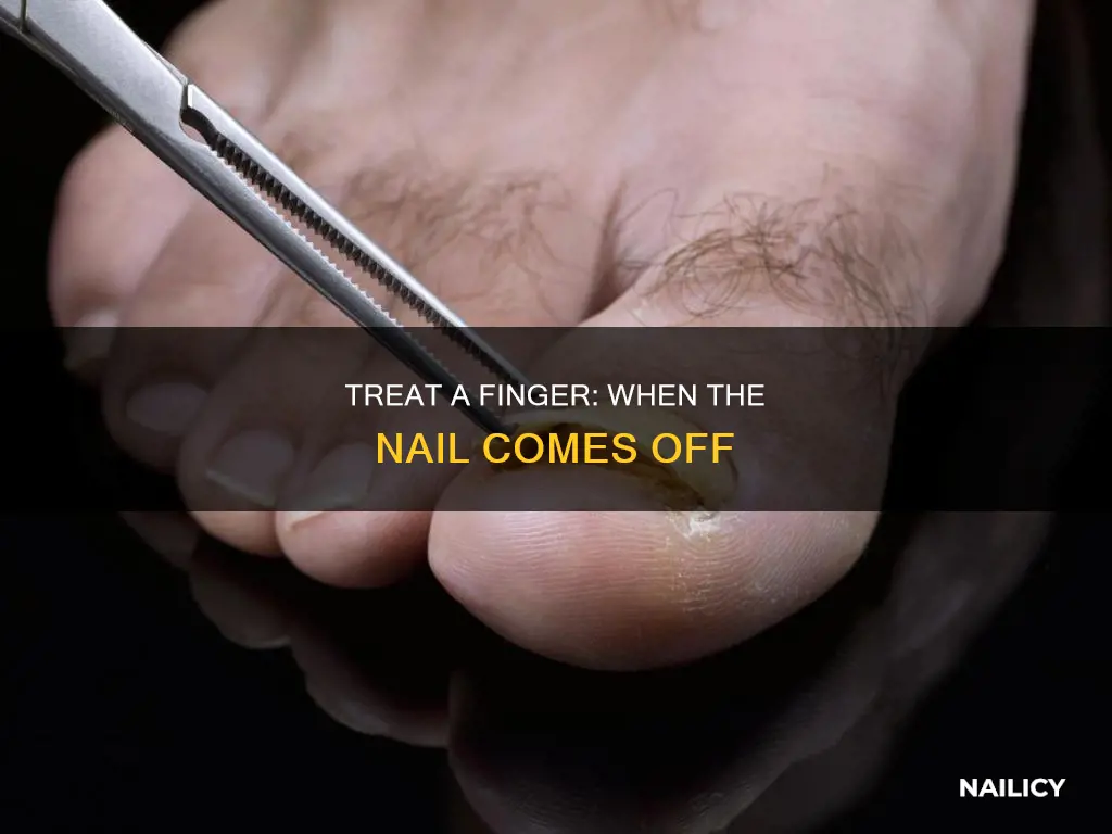 how to treat a finger when the nail comes off