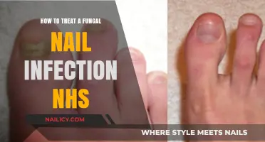 Effective NHS-Approved Treatments for Fungal Nail Infections: A Comprehensive Guide
