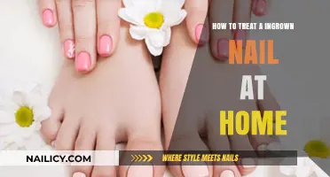 Effective Home Remedies for Treating Painful Ingrown Nails Safely