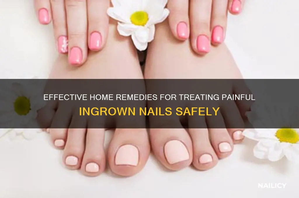 how to treat a ingrown nail at home