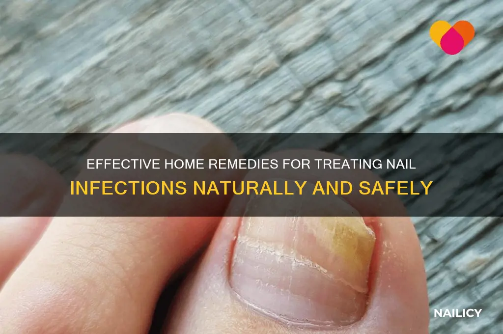 how to treat a nail infection at home