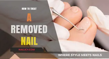 Treating a Removed Nail: Steps to Recovery