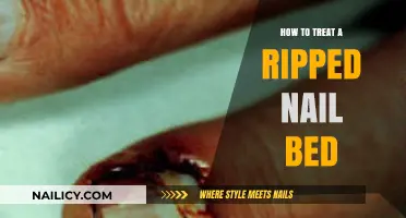 Quick Relief: Effective Treatments for a Ripped Nail Bed Injury