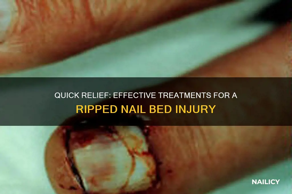 how to treat a ripped nail bed