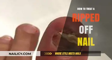 Quick Relief: Effective Ways to Treat a Ripped-Off Nail