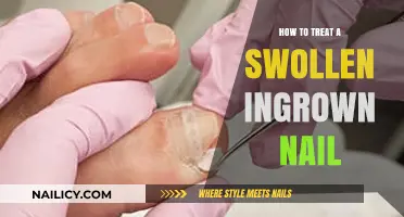 Effective Remedies for Treating a Painful, Swollen Ingrown Toenail at Home