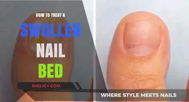 Effective Remedies for Treating a Swollen Nail Bed at Home