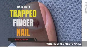 Treating a Trapped Fingernail: Quick and Easy Home Remedies