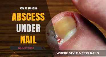Effective Home Remedies and Medical Treatments for Nail Abscess Relief