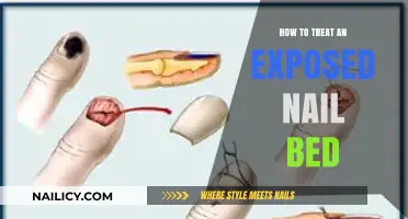 Treating an Exposed Nail Bed: Quick Relief and Healing Tips