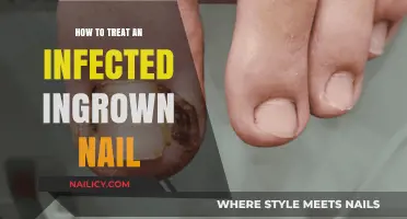 Effective Treatment Tips for Painful, Infected Ingrown Toenails at Home