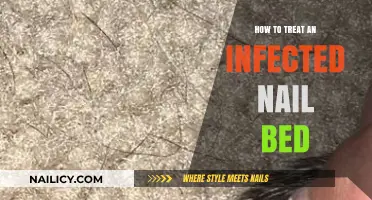 Effective Treatment Tips for Healing an Infected Nail Bed