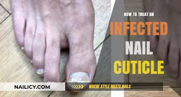 Effective Home Remedies and Treatments for Infected Nail Cuticles