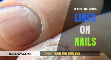Effective Treatments for Beau's Lines: Restoring Nail Health Naturally